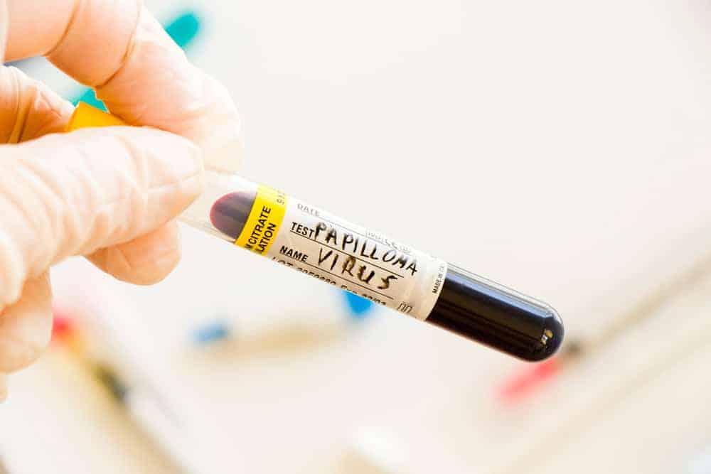 cách đọc kết quả xét nghiệm hpv