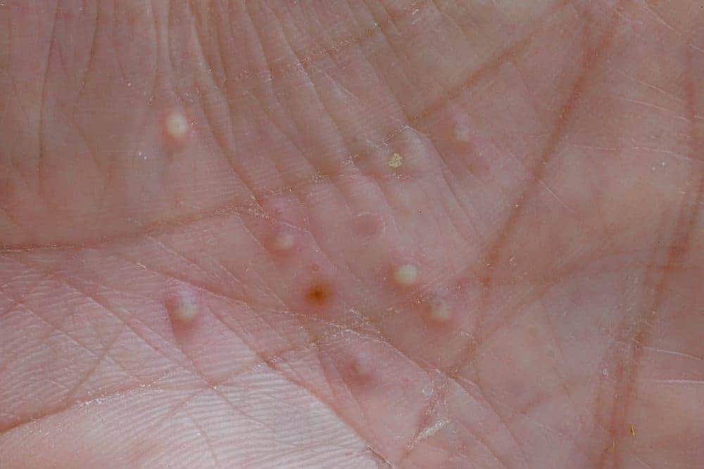 Vảy nến thể mủ: Nguyên nhân, Triệu chứng và Cách điều trị