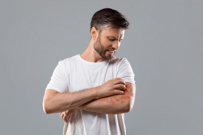 Cách nhận biết viêm da cơ địa bội nhiễm và phòng ngừa bệnh tái phát