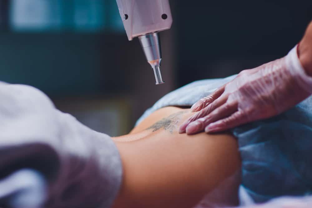 Xóa xăm: Phương pháp nào hiệu quả cho bạn?