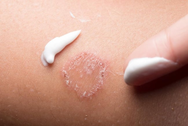 Bị nổi vòng tròn đỏ trên da là bệnh gì?