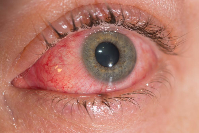 Nhiễm virus viêm kết mạc (Viêm kết mạc do virus)