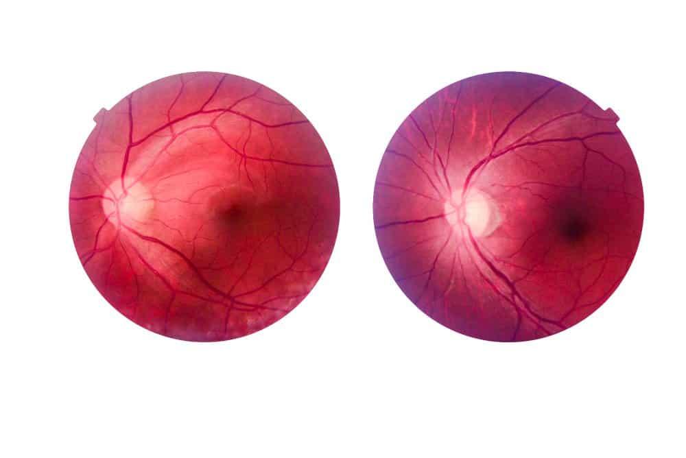 Thoái hóa võng mạc có chữa được không và toàn bộ thông tin về bệnh