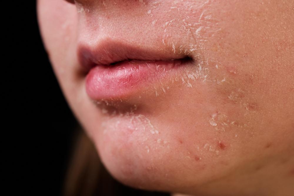 Hỏi đáp Bác sĩ: Lột da mặt bị đỏ phải làm sao?