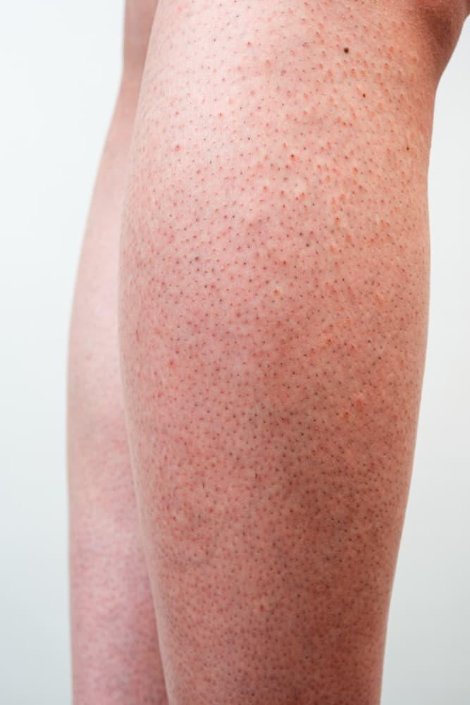 Nhận biết và cách khắc phục viêm lỗ chân lông ít ai biết