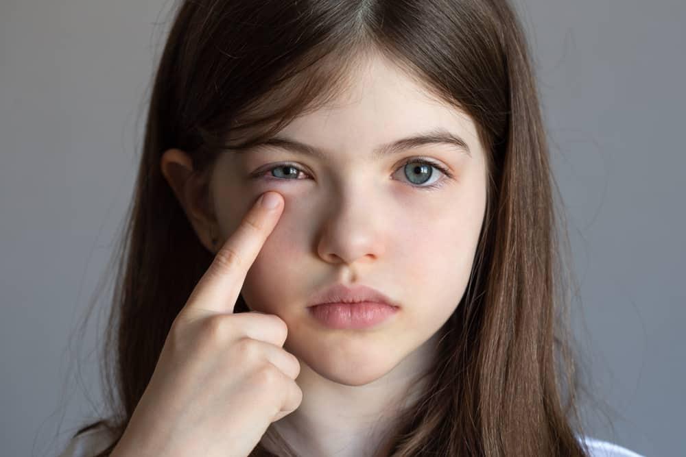 Đau mắt đỏ lây qua đường nào? Hiểu rõ để phòng ngừa