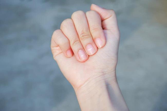 Móng tay bị sọc đen và trắng là thiếu chất gì?