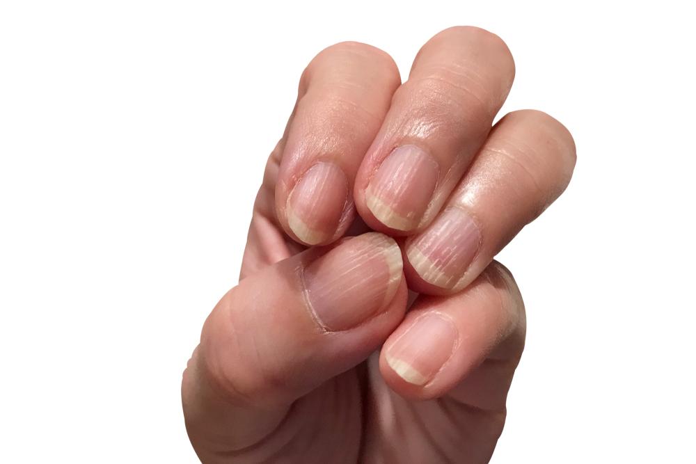 Móng tay bị sọc là thiếu chất gì? Dấu hiệu không thể lơ là!