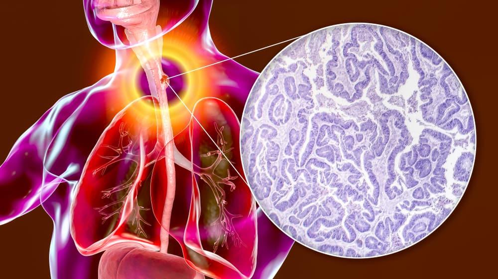 Ung thư thực quản giai đoạn 1