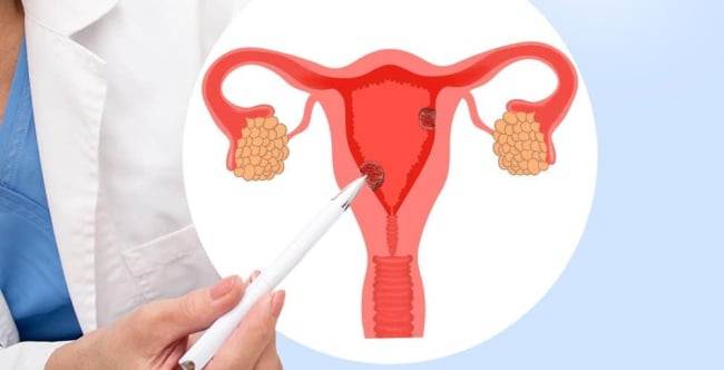 Bị polyp cổ tử cung có quan hệ được không?