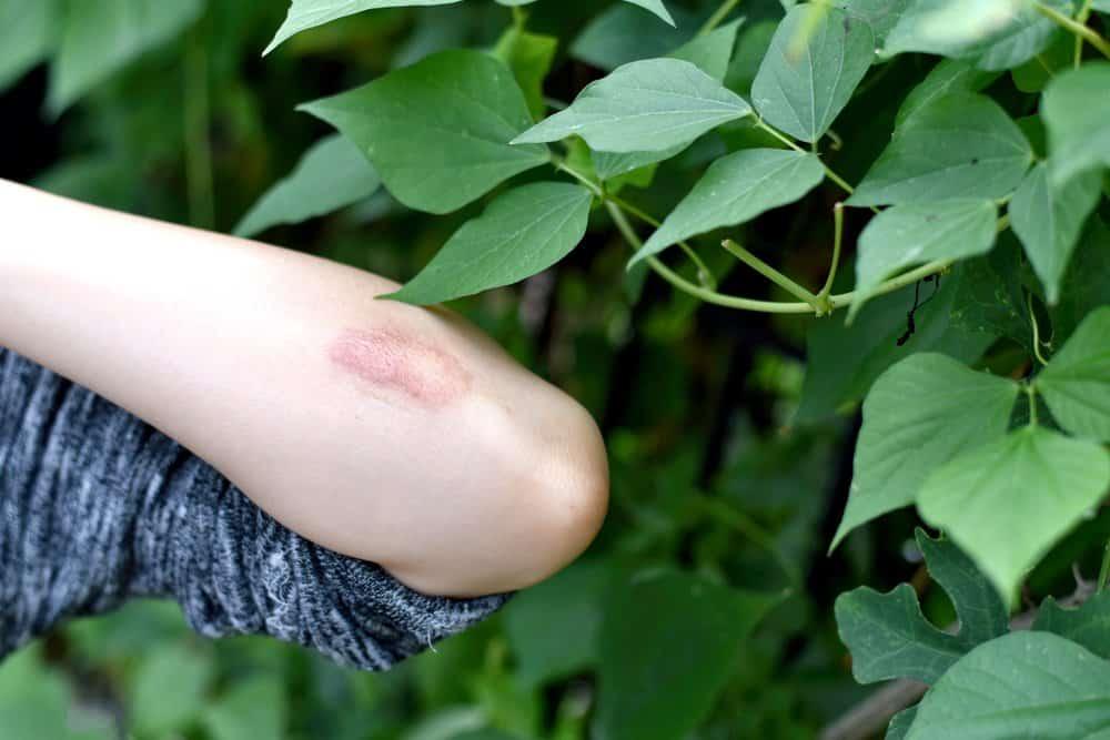 6 cây thuốc trị ngứa ngoài da dễ tìm mà hiệu quả