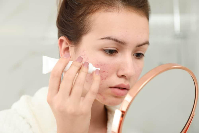 Cách chọn và dùng kem trị mụn hiệu quả, bạn đã biết chưa?