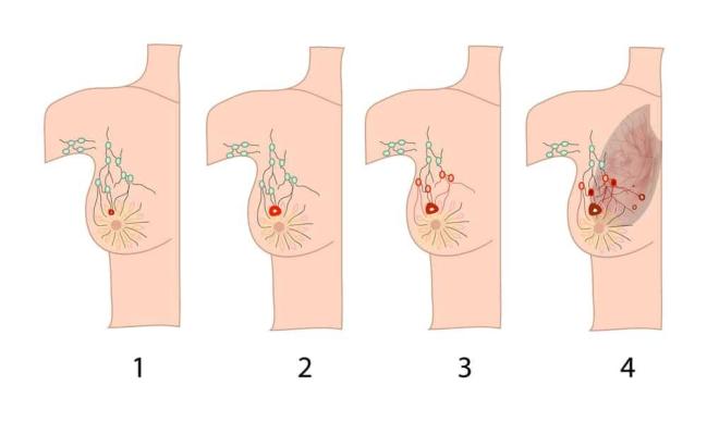 Ung thư vú giai đoạn đầu và những điều bạn cần biết