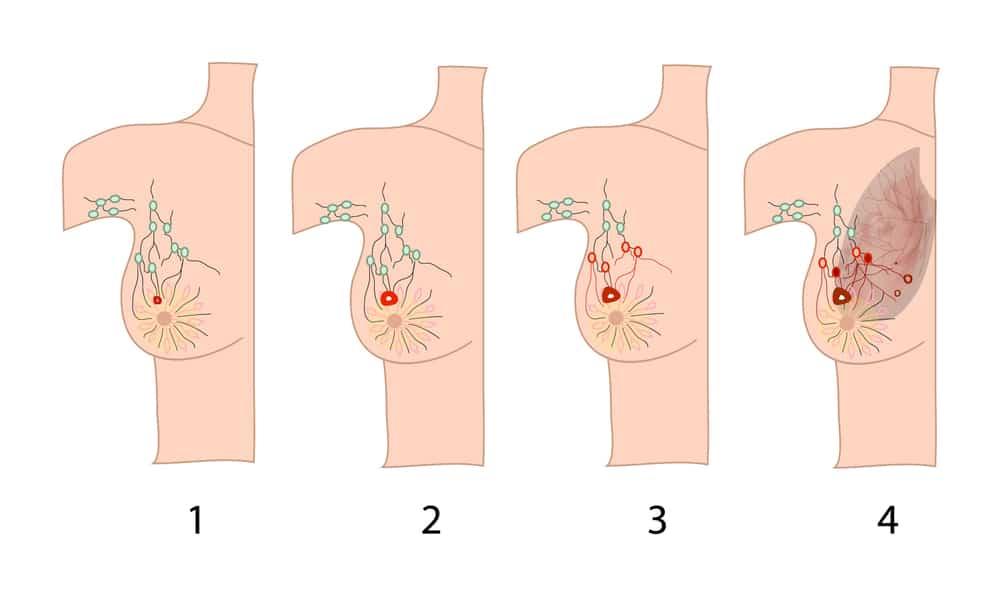 Ung thư vú giai đoạn đầu và những điều bạn cần biết