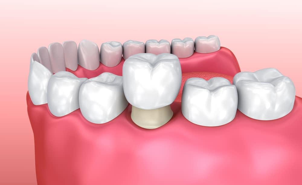 Bọc răng sứ có đau không? Bọc răng sứ bị đau do đâu?