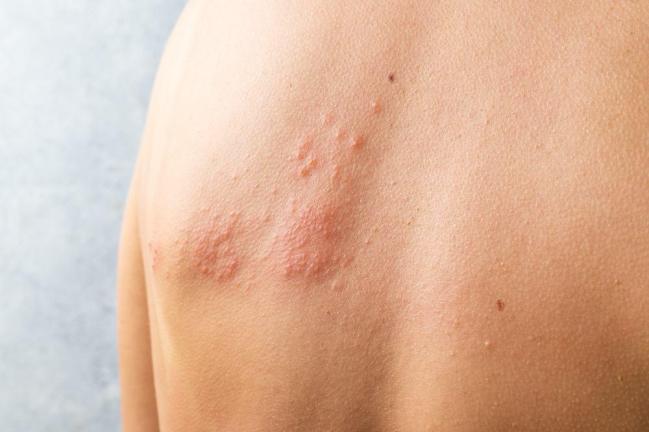 Dấu hiệu bệnh zona sắp khỏi là gì? Hiểu để biết cách chăm sóc