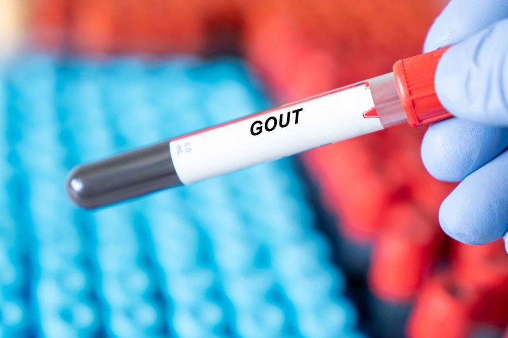 Nguyên nhân bệnh gout: Biết để phòng ngừa