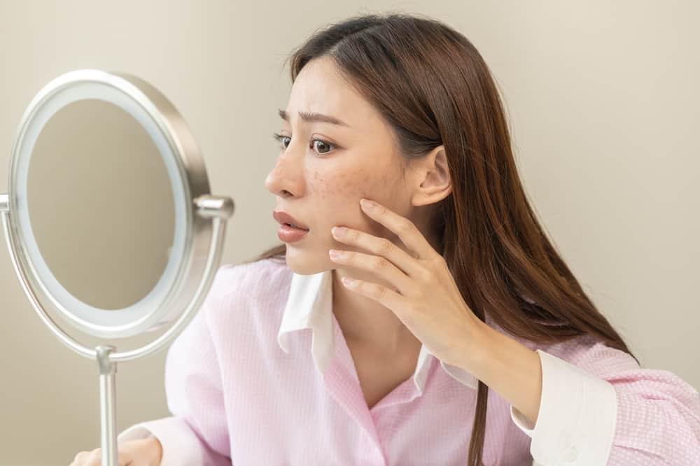 điều trị nám da sai cách
