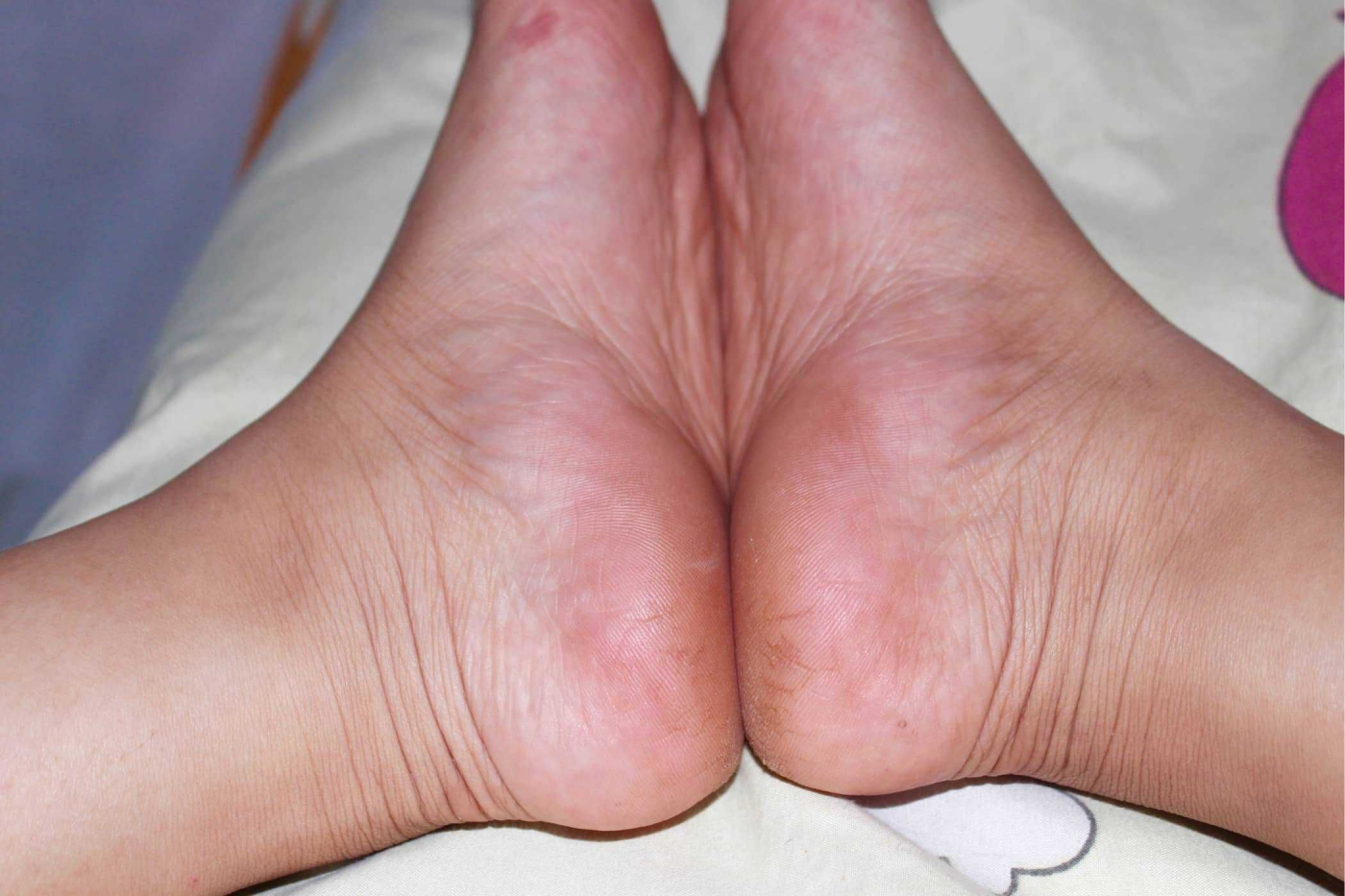 Bị nứt gót chân là thiếu chất gì? 3 vitamin cần thiết bạn nên bổ sung ngay