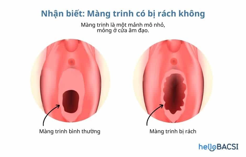 Rách Màng Trinh Có Hiện Tượng Gì? - Tìm Hiểu Chi Tiết và Hướng Dẫn Chăm Sóc