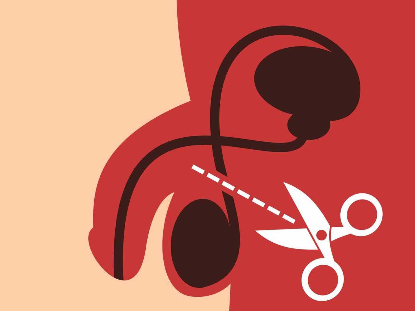 Thắt ống dẫn tinh thì tinh trùng đi đâu? Ảnh hưởng gì không?