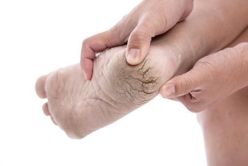 Gót chân bị nứt đen: Nguyên nhân và cách điều trị