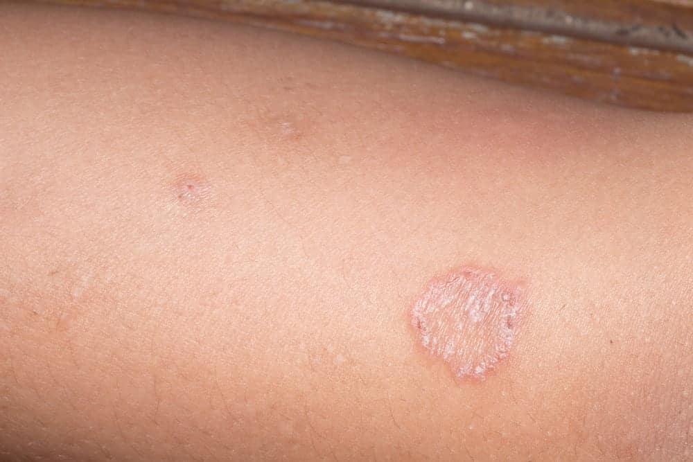 Các loại nấm da và cách ngăn ngừa bệnh hiệu quả