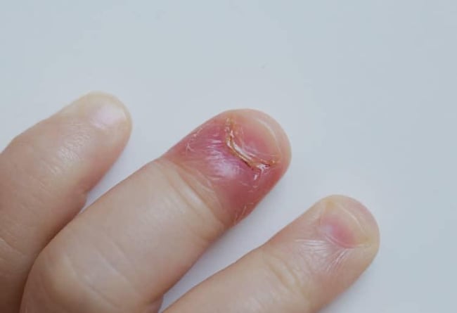 Móng tay bị nấm có nguy hiểm không?
