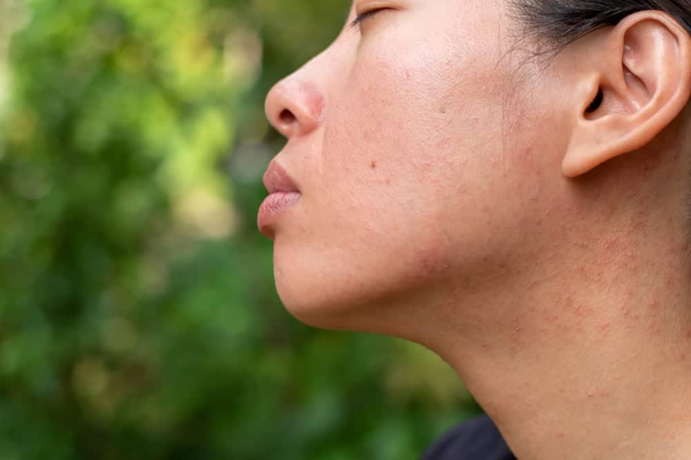 6 dấu hiệu dị ứng mỹ phẩm cần phát hiện sớm để điều trị