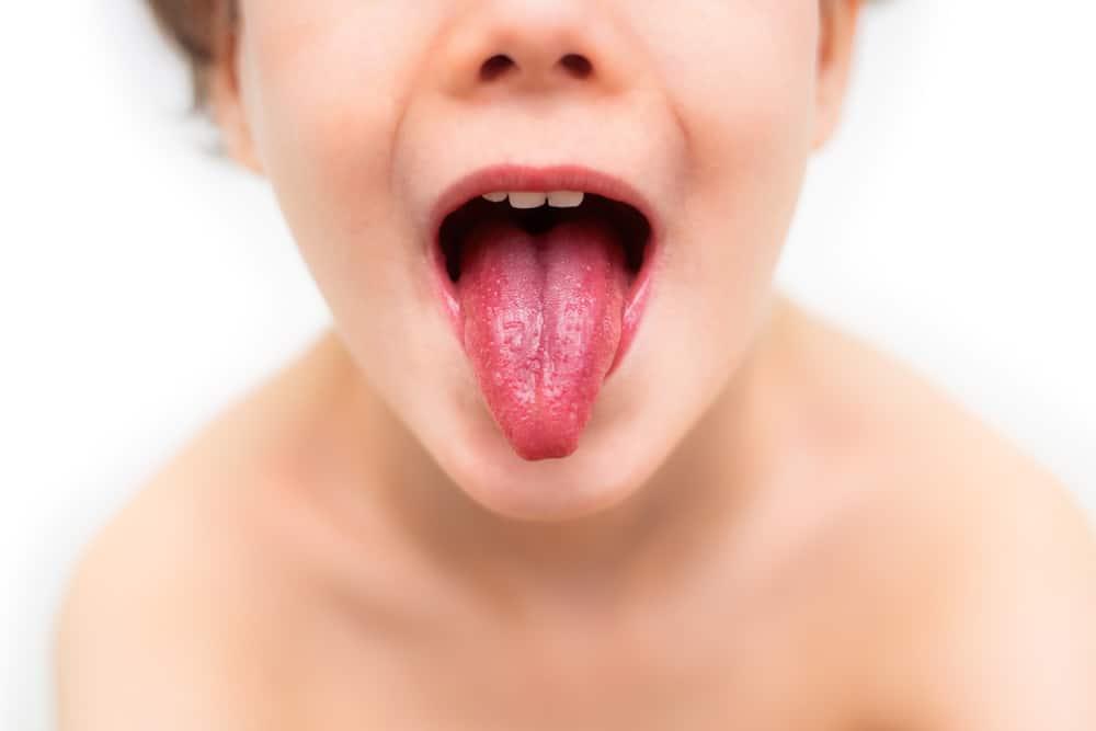 Lưỡi dâu tây cảnh báo điều gì? Làm sao để nhận biết và điều trị?