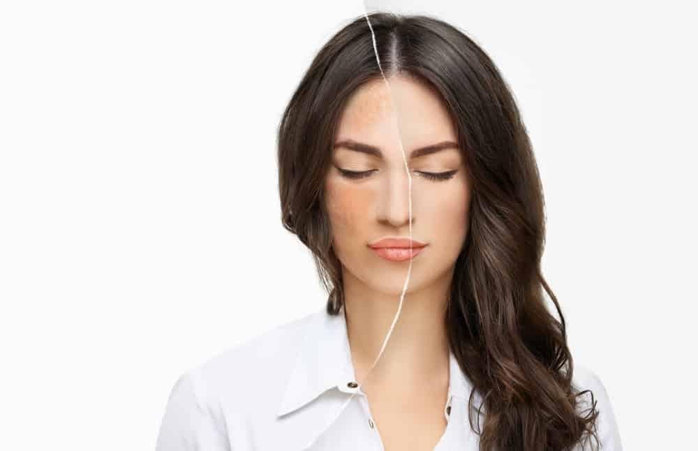 Làm sao hết nám da mặt? Review top 5 kem trị nám hiệu quả