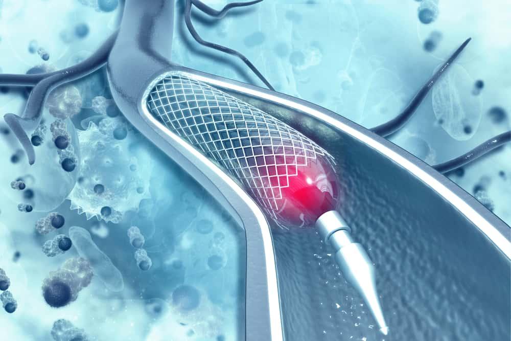 Đặt stent là gì? Quy trình và biến chứng thường gặp