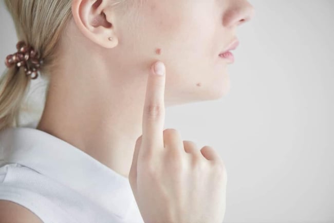 Tẩy Nốt Ruồi Thì Kiêng Ăn Gì