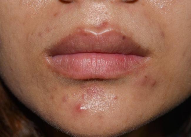 Mụn bọc ở cằm có nên nặn không? Nguyên nhân & cách điều trị