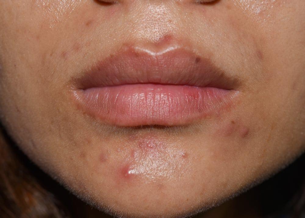 Mụn bọc ở cằm có nên nặn không? Nguyên nhân & cách điều trị