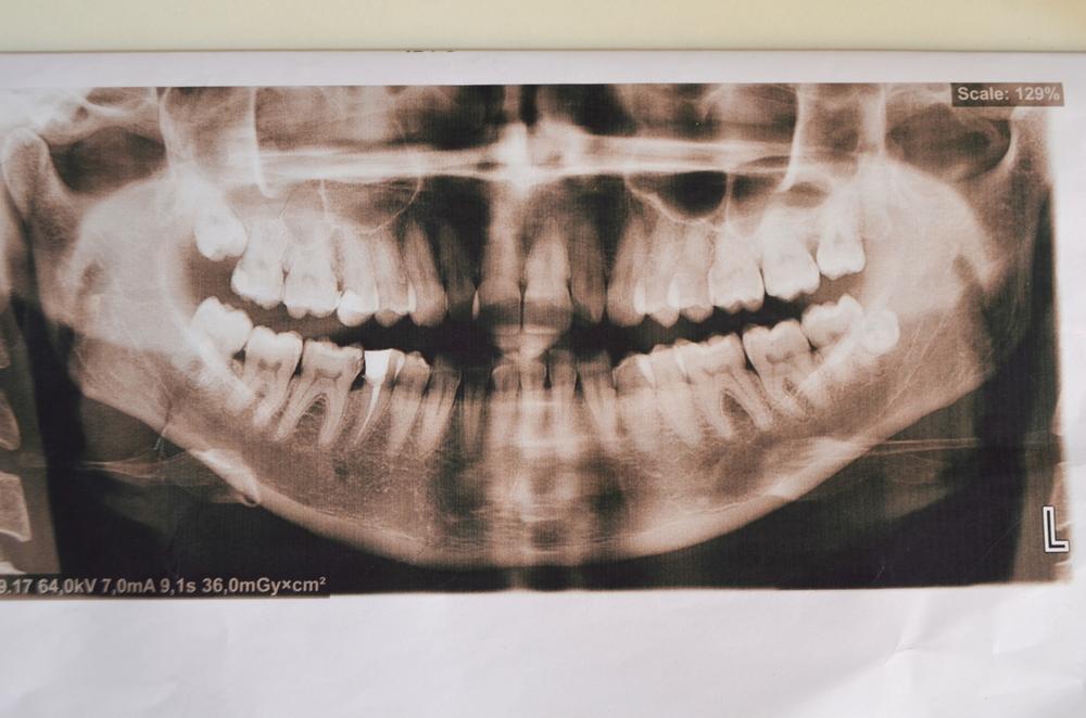 Răng mọc thừa có nguy hiểm không, khi nào cần phải nhổ bỏ?