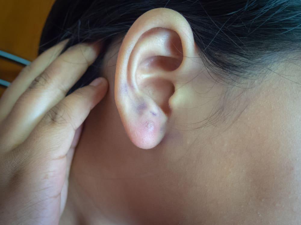 Nguyên nhân vành tai bị sưng ngứa và cách xử lý nhanh