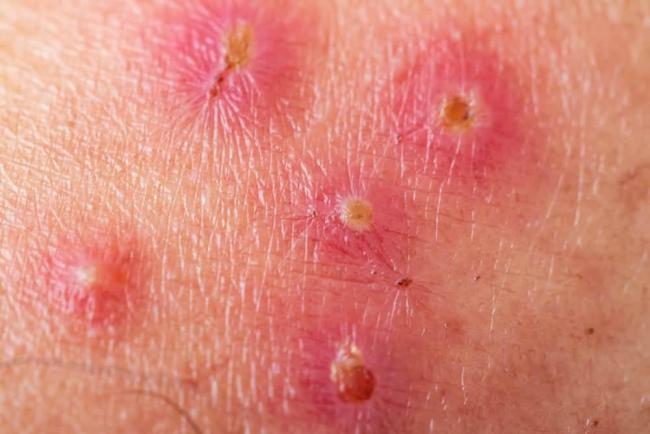 Viêm da liên cầu là bệnh gì? Cách nhận biết và điều trị