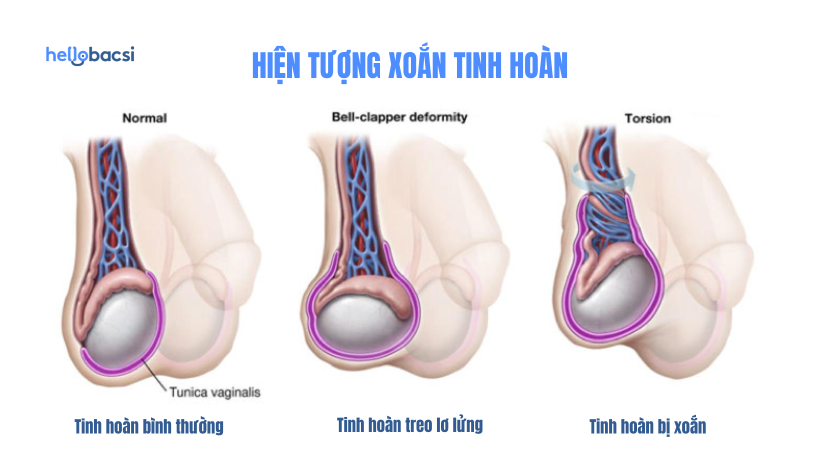 Xoắn tinh hoàn là gì? Nguyên nhân, triệu chứng, cách điều trị