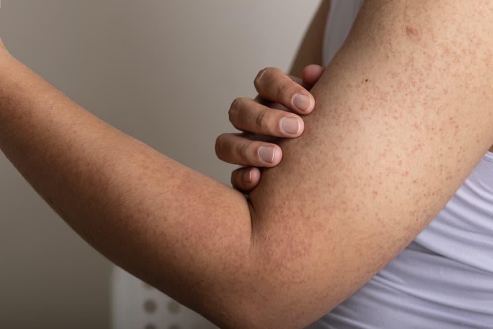 Da bị nổi sần như da gà và ngứa: Cảnh báo bệnh Keratosis pilaris