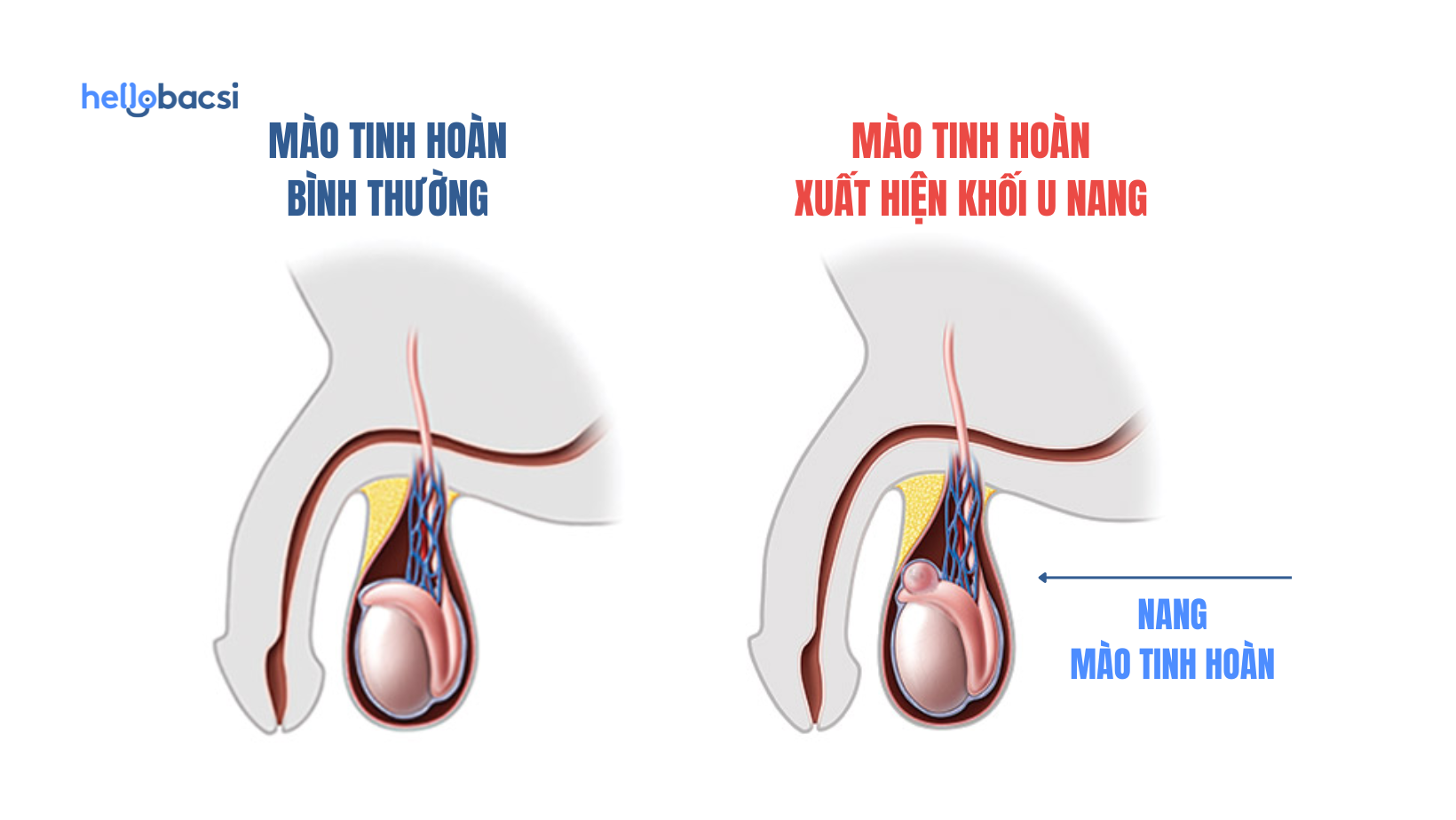 Nang mào tinh hoàn là gì? Bệnh có nguy hiểm không?