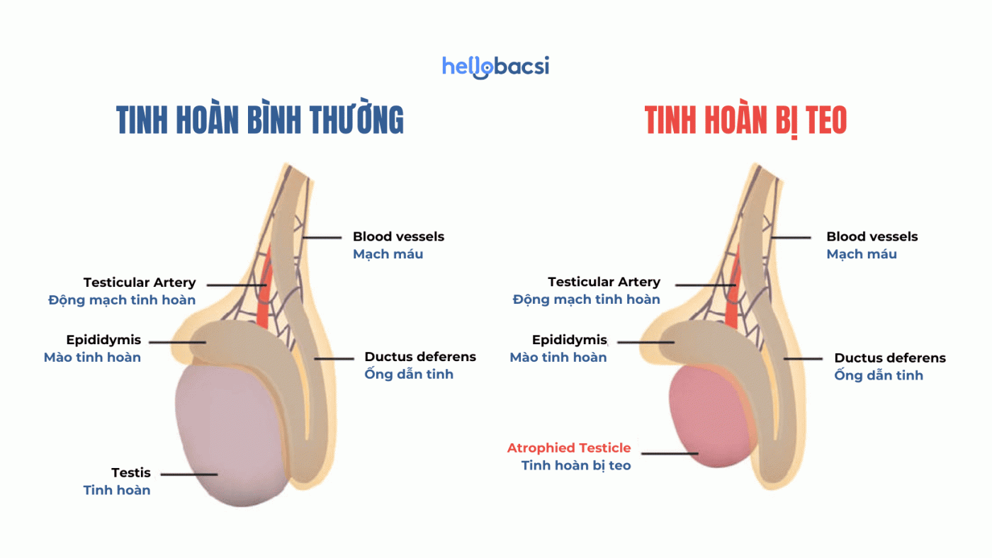 Nam giới bị teo tinh hoàn có chữa được không?