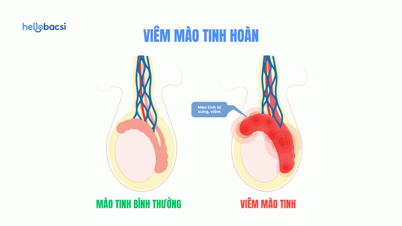 Viêm mào tinh hoàn là gì? Nguyên nhân, triệu chứng, chẩn đoán và điều trị