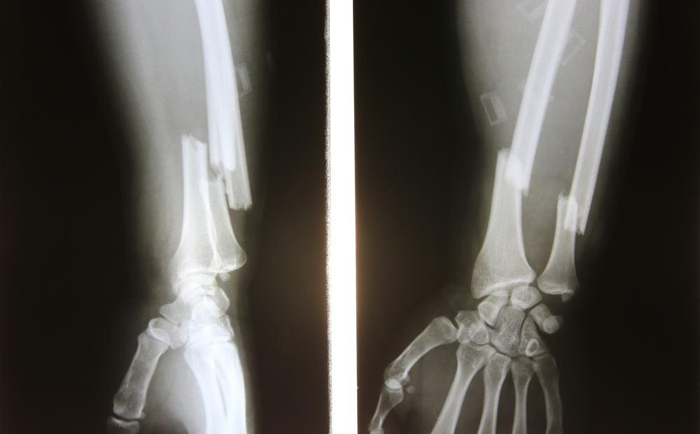 Dấu hiệu xương không lành: Điều gì bạn cần biết?