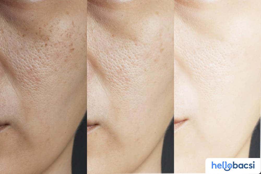Glutathione trắng da
