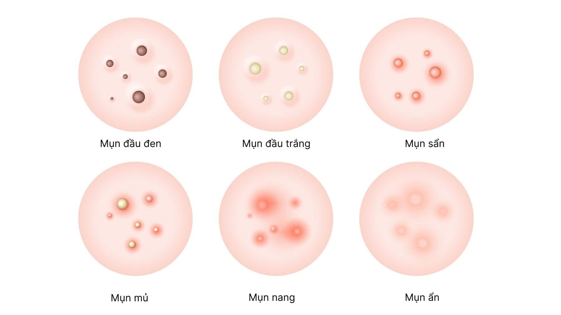 Phân biệt các loại mụn: Cách nhận biết, nguyên nhân & cách điều trị