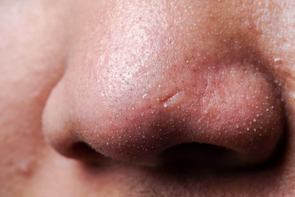 Sợi bã nhờn là gì? Nguyên nhân và cách điều trị sợi bã nhờn