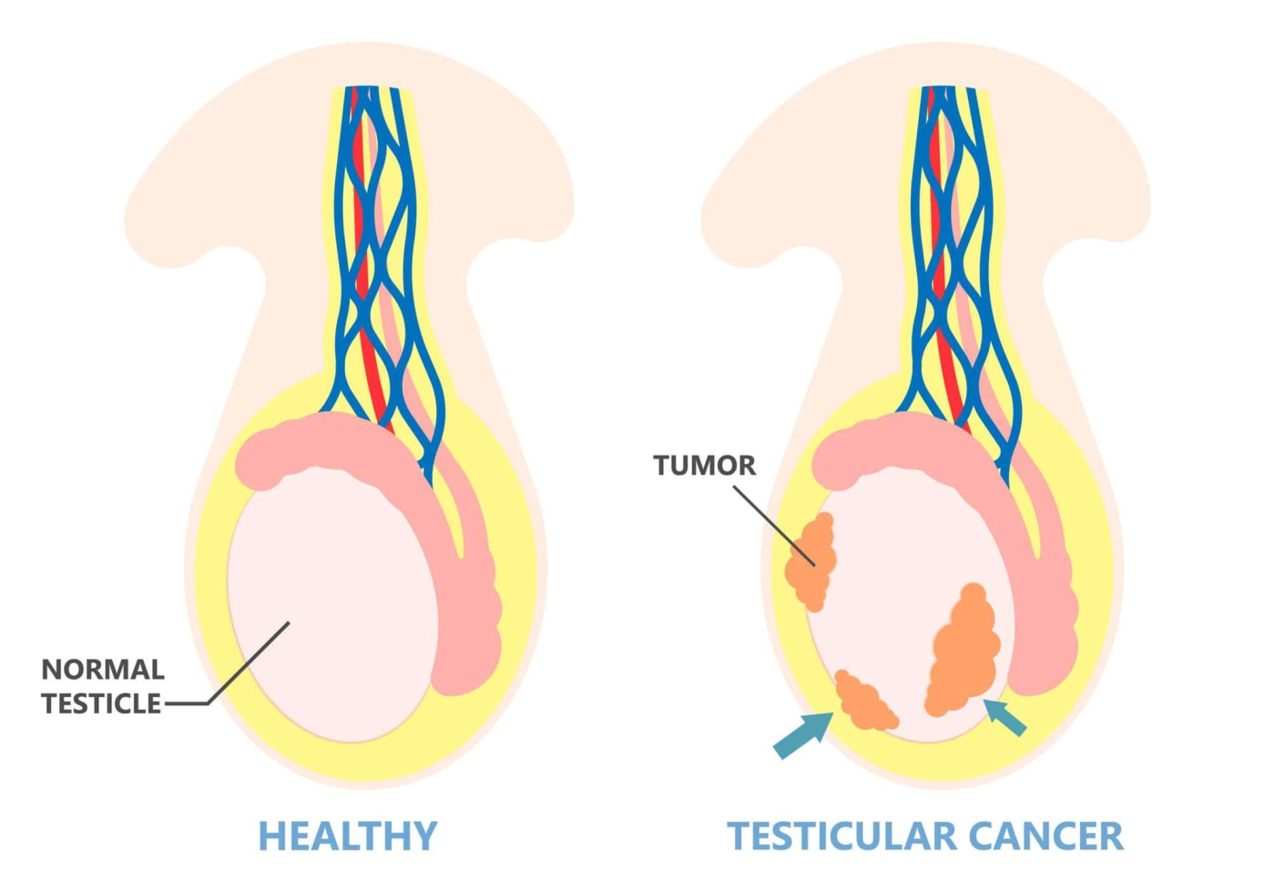 U tinh hoàn là gì? Khối u tinh hoàn có phải là ung thư không?