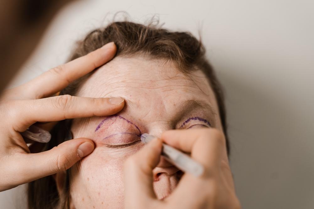 Phẫu thuật mí mắt: Quy trình, rủi ro và cách hồi phục nhanh chóng