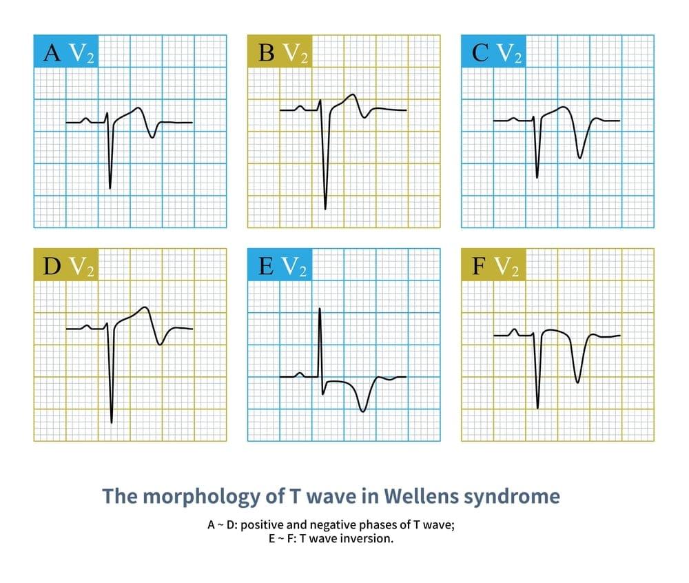 Hội chứng Wellen - Dấu hiệu cảnh báo nhồi máu cơ tim cấp
